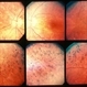 Retinitis Pigmentosa